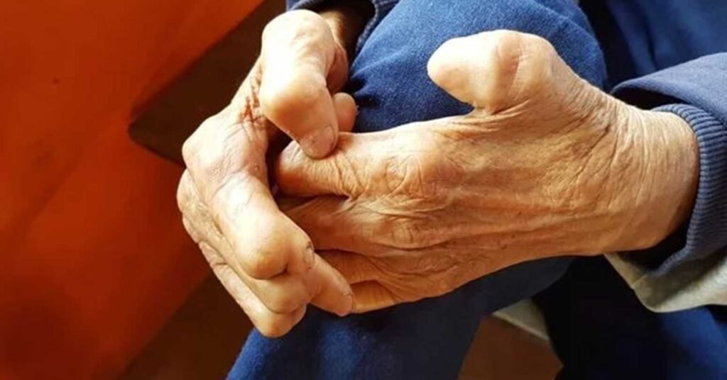 खुला सिमाना र घना बस्तीको असर, मधेसमा कुष्ठरोग उच्च जोखिममा